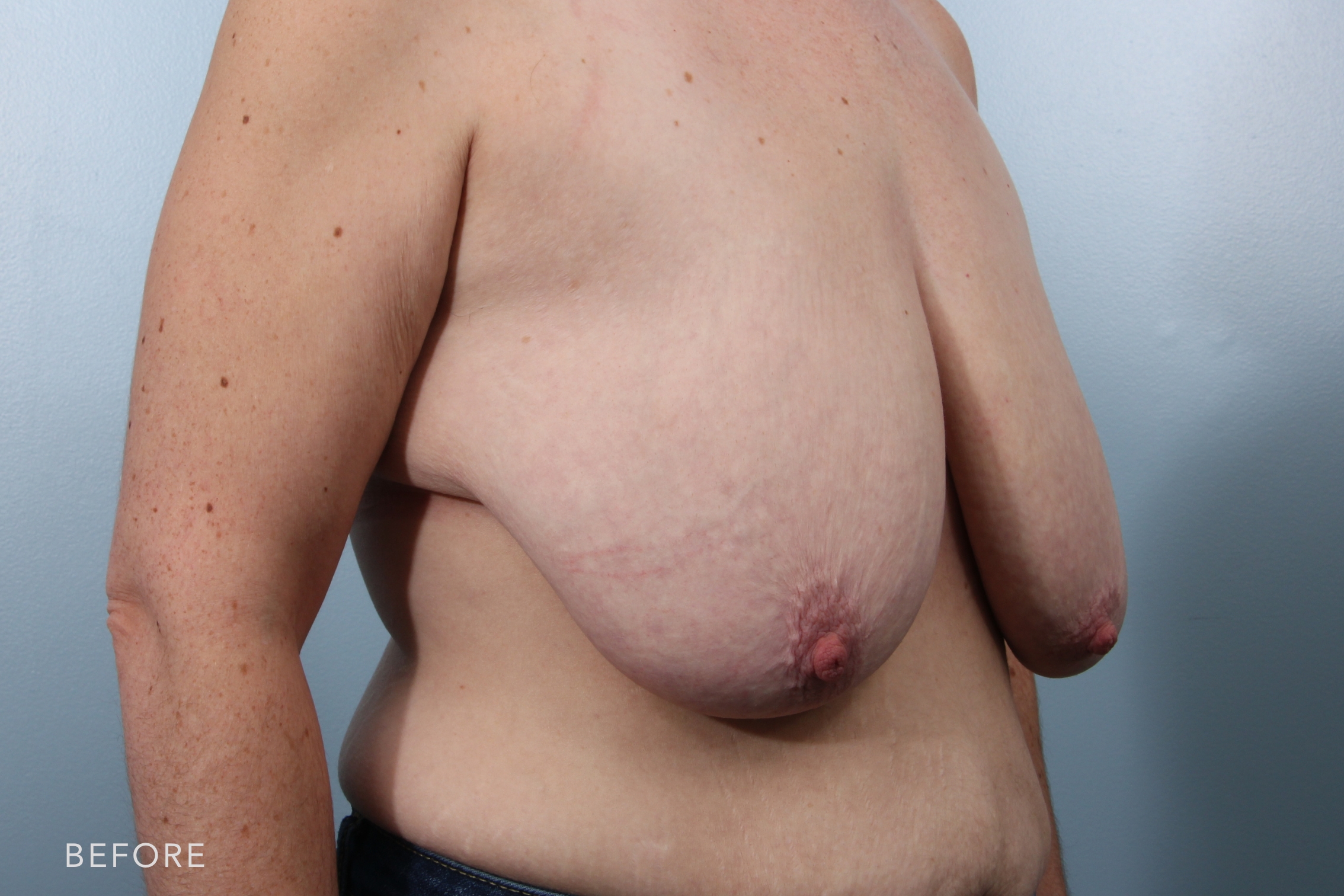 Mommy Makeover by Dr. Alfredo Lloreda — before