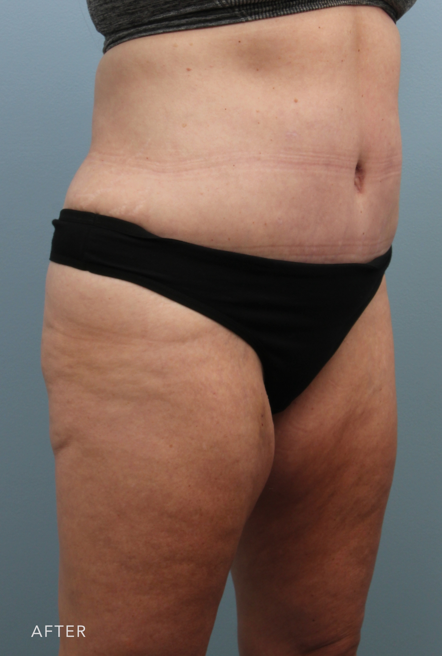 Tummy Tuck after — Dr. Alfredo Lloreda