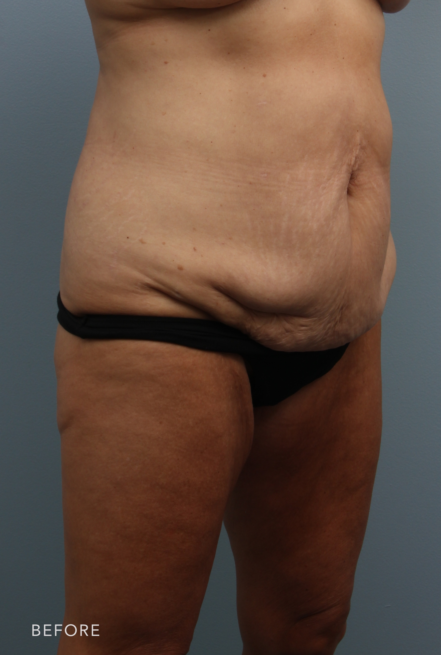 Tummy Tuck before — Dr. Alfredo Lloreda