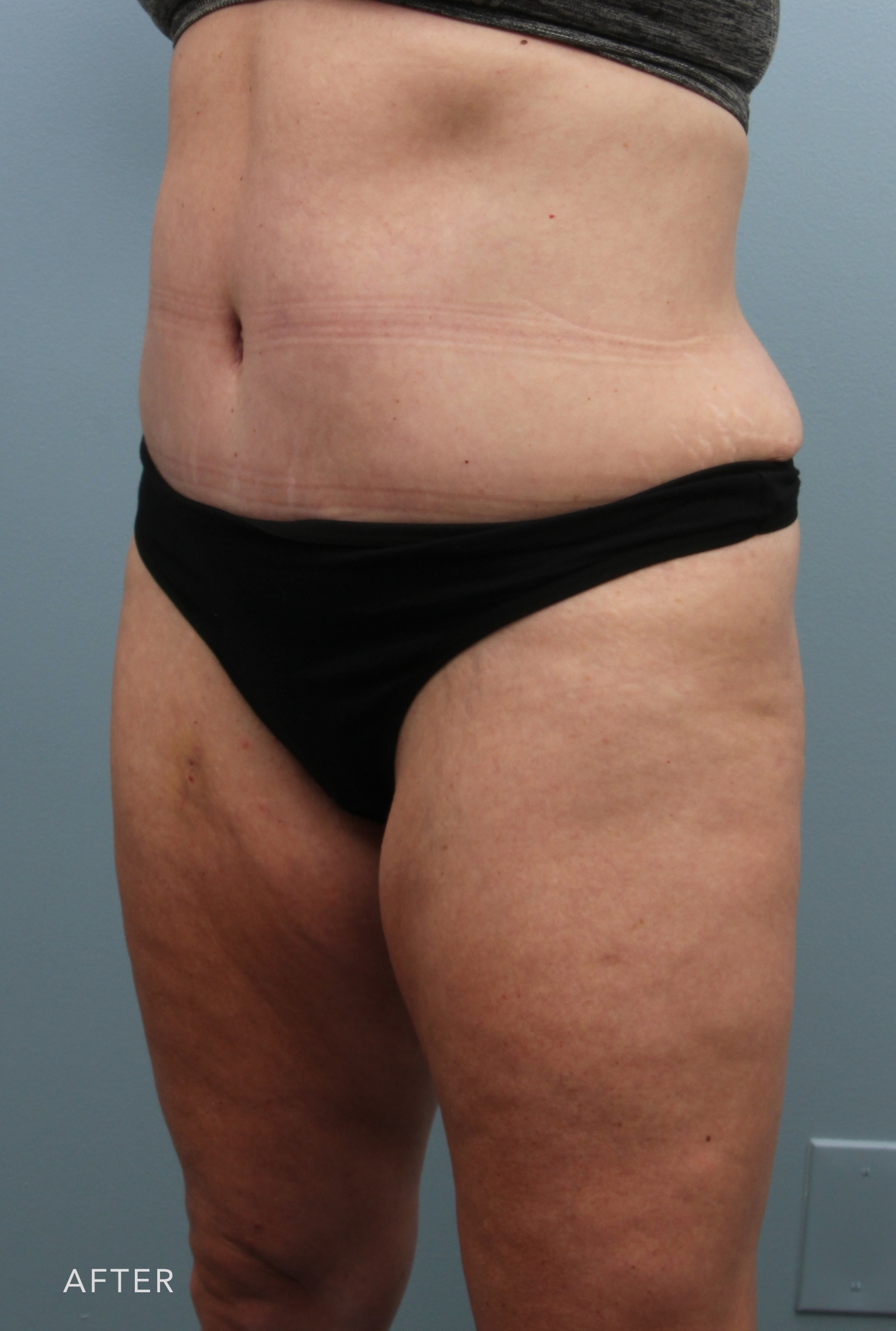 Tummy Tuck after — Dr. Alfredo Lloreda