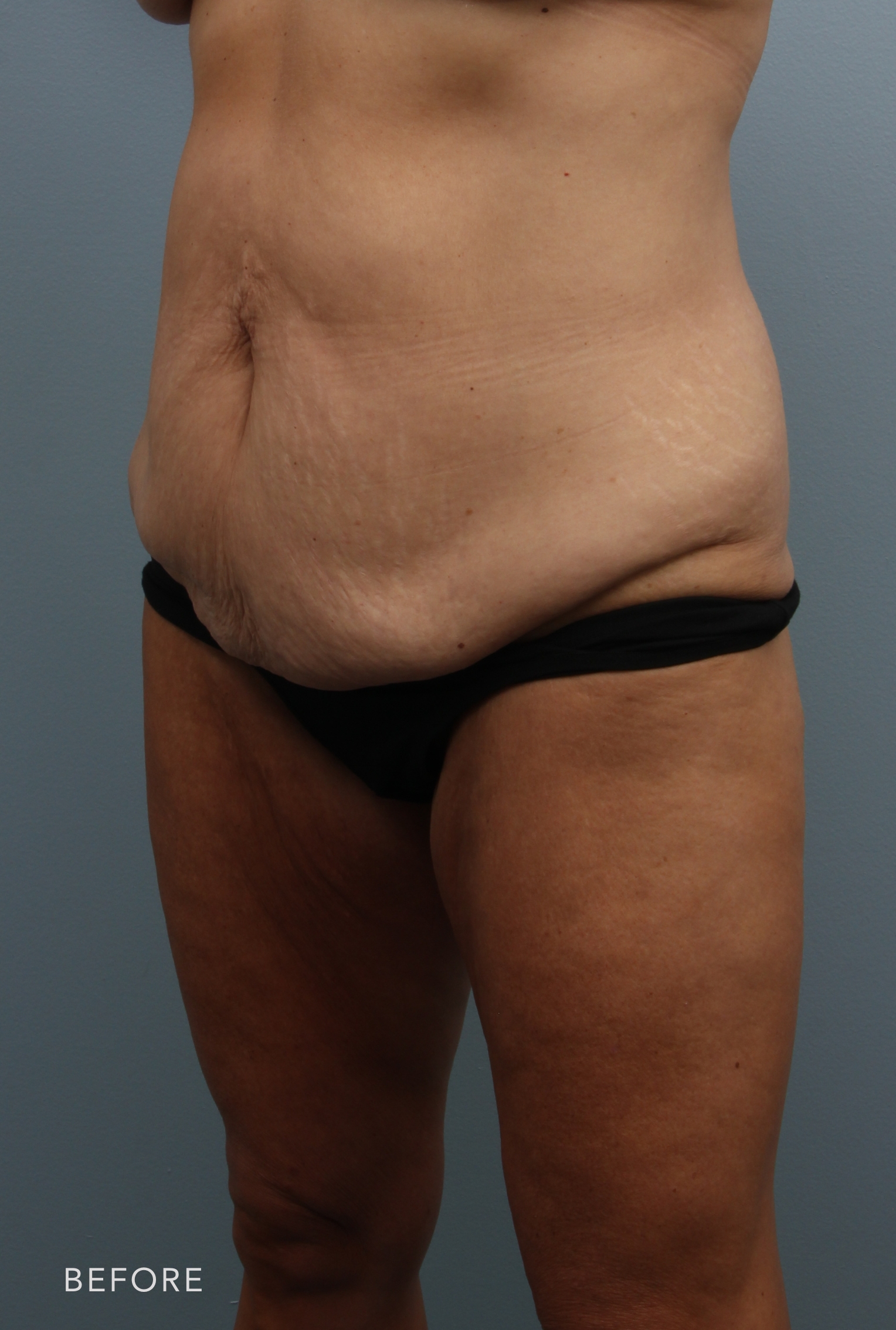 Tummy Tuck before — Dr. Alfredo Lloreda