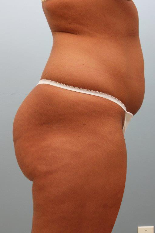 Liposuction before and after - before