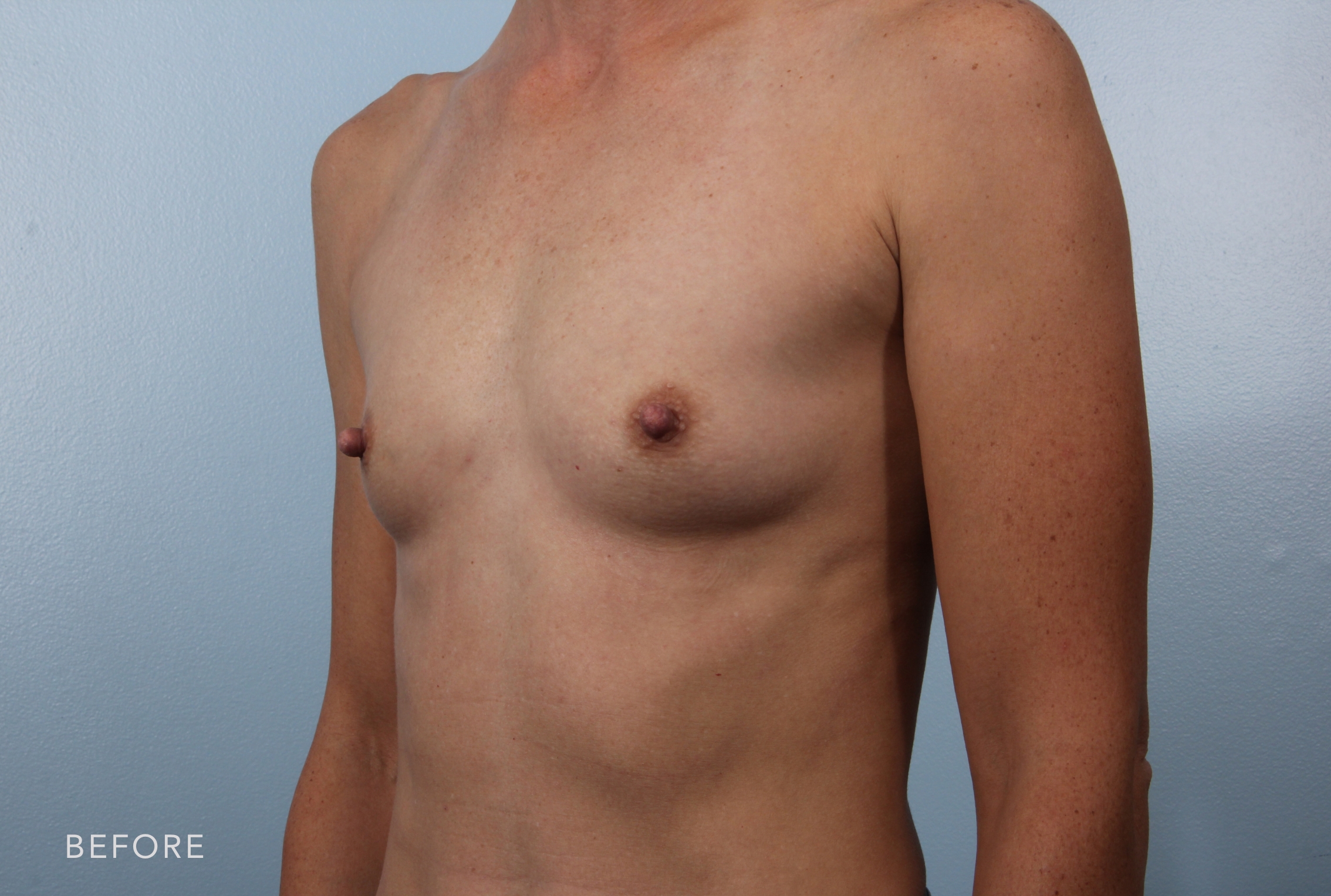 Breast Augmentation before and after - before
