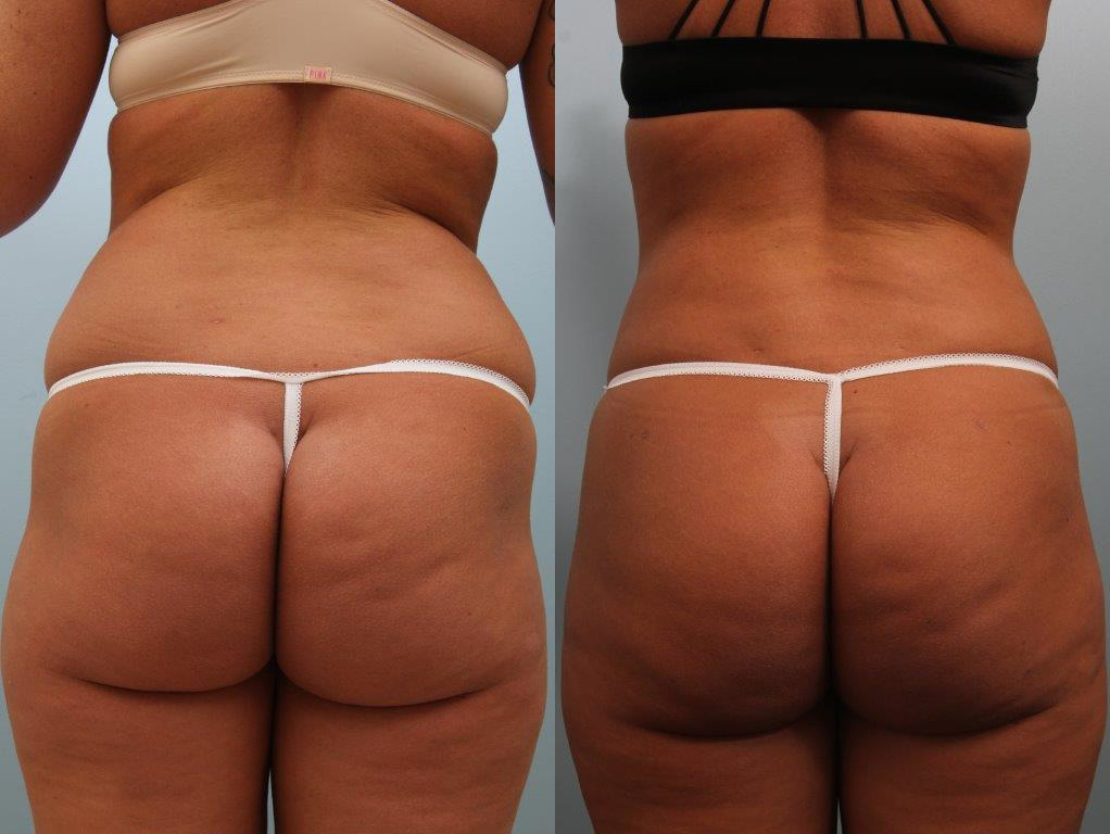 Brazilian Butt Lift by Dr. Alfredo Lloreda — before