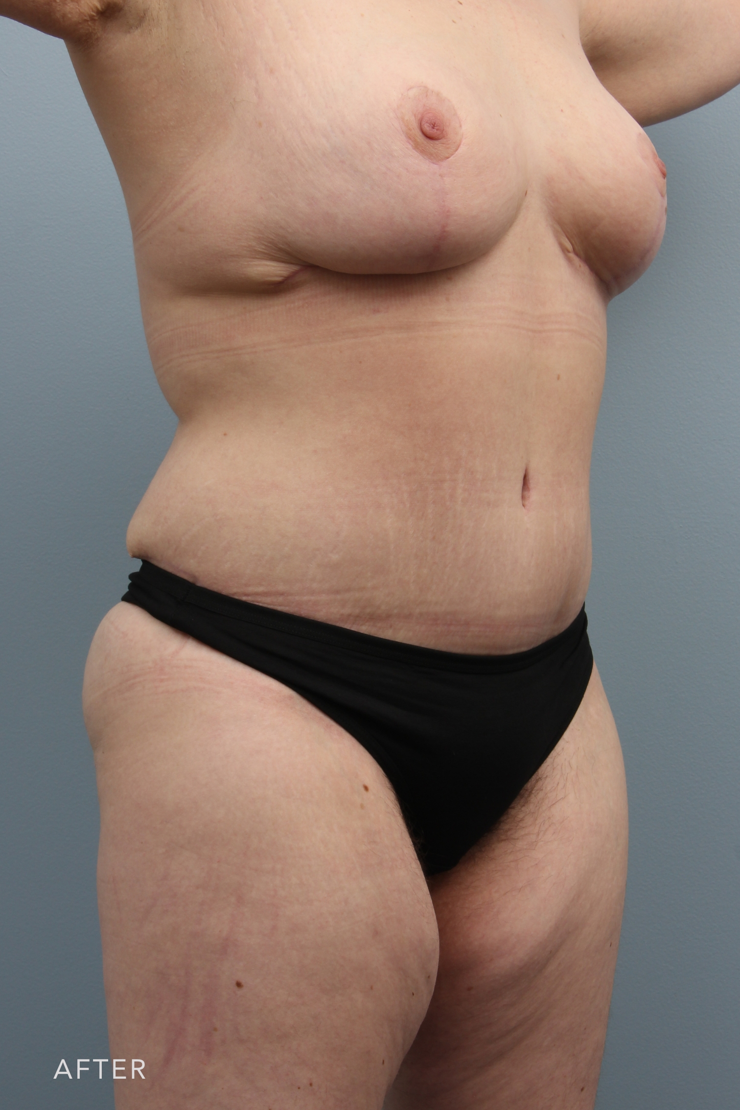 Mommy Makeover before and after - after