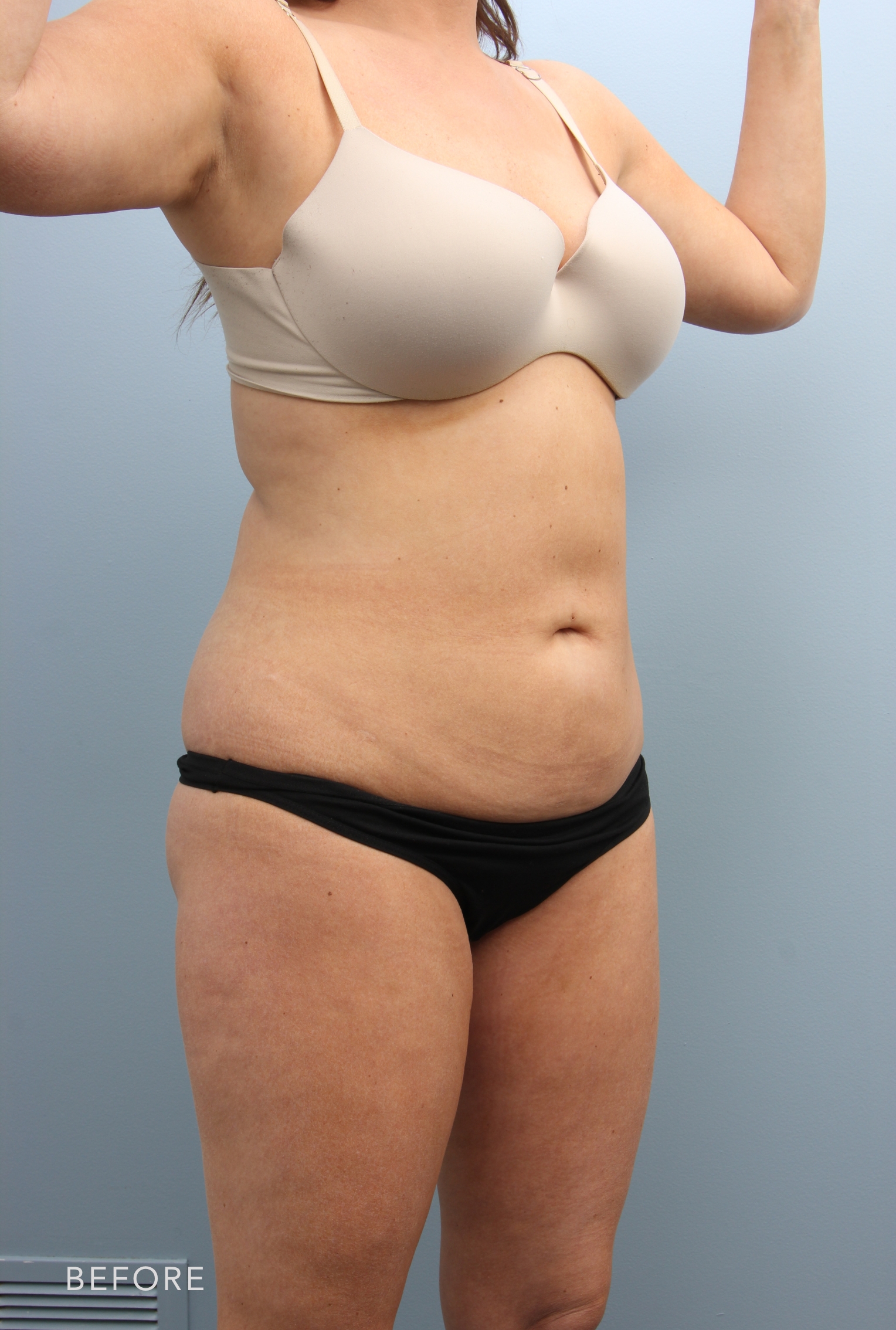 Tummy Tuck before — Dr. Alfredo Lloreda
