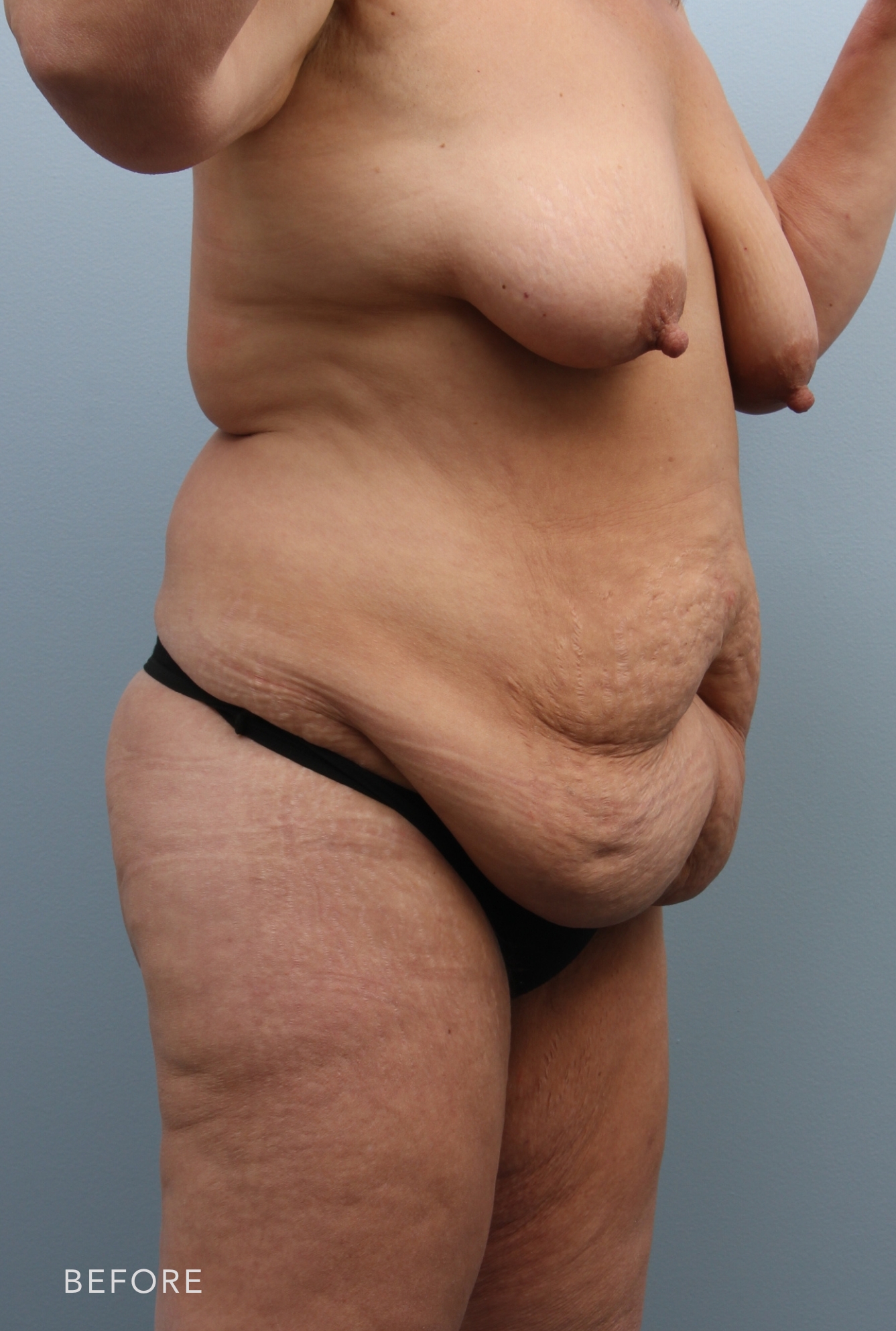Procedure before and after - before