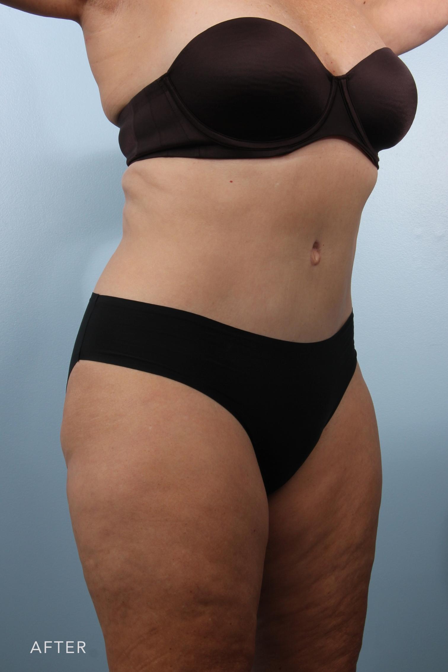 Tummy Tuck before and after - after