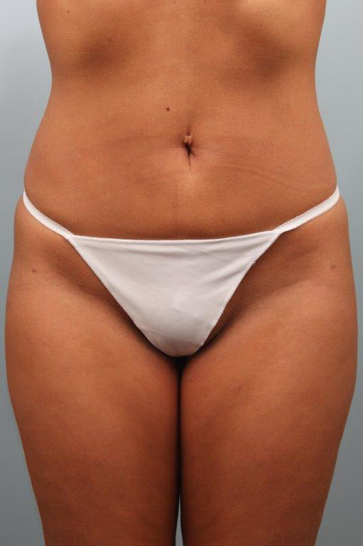 Liposuction before and after - after