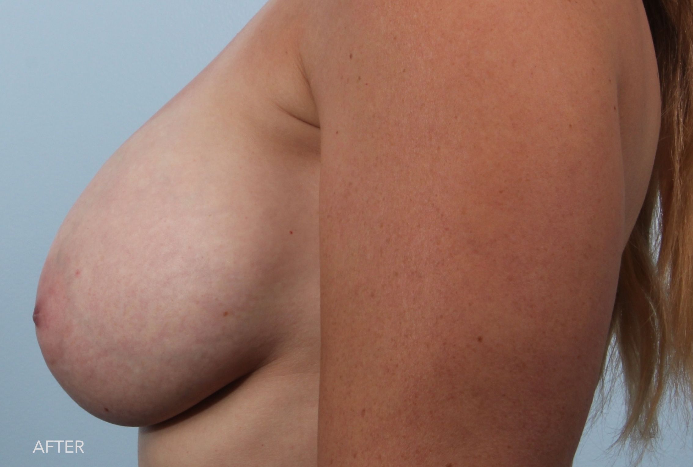 Breast Augmentation before and after - after