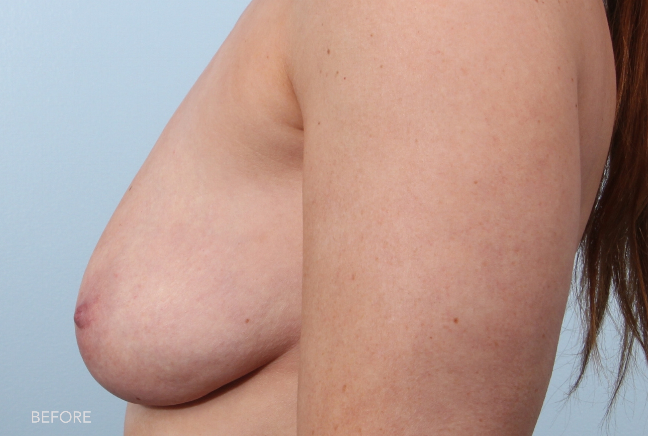 Breast Augmentation before and after - before