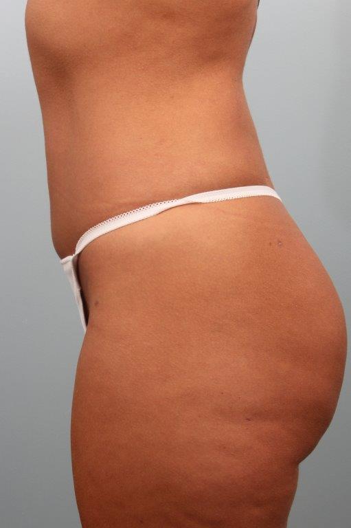 Brazilian Butt Lift by Dr. Alfredo Lloreda — after