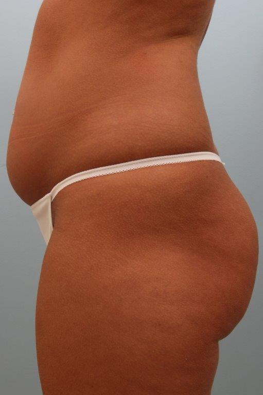 Brazilian Butt Lift by Dr. Alfredo Lloreda — before
