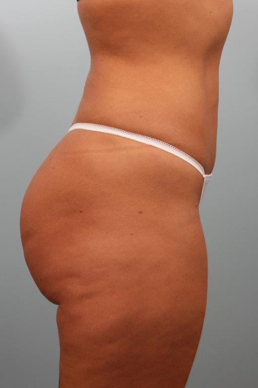 Liposuction before and after - after