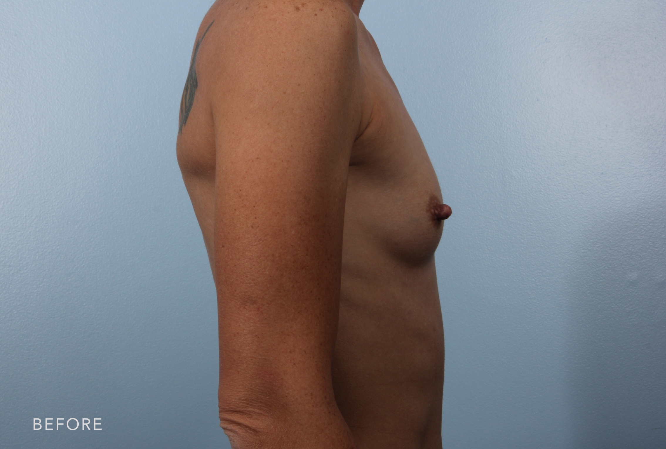 Breast Augmentation before and after - before