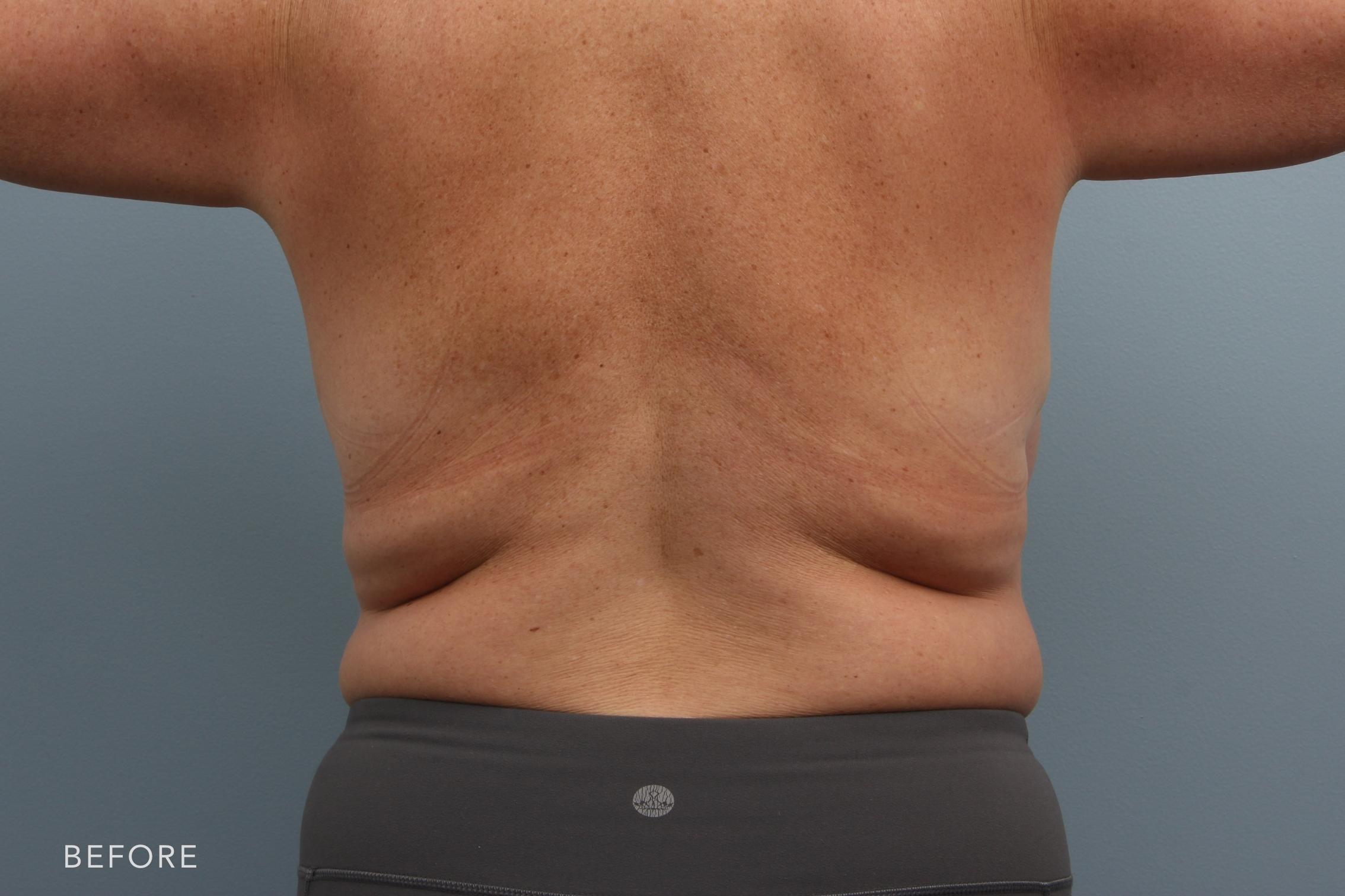 Liposuction before and after - before