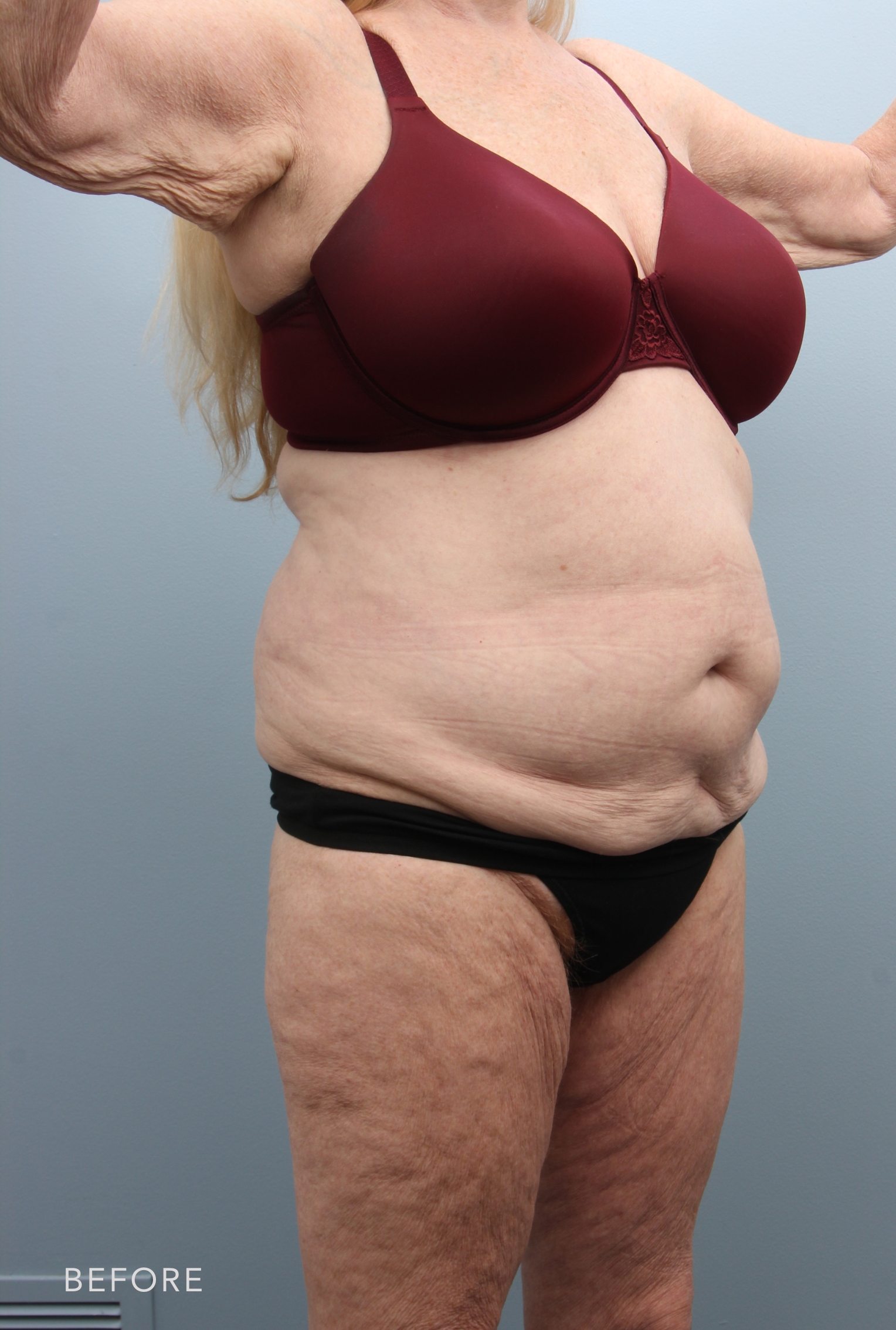 Body Lift before — Dr. Alfredo Lloreda