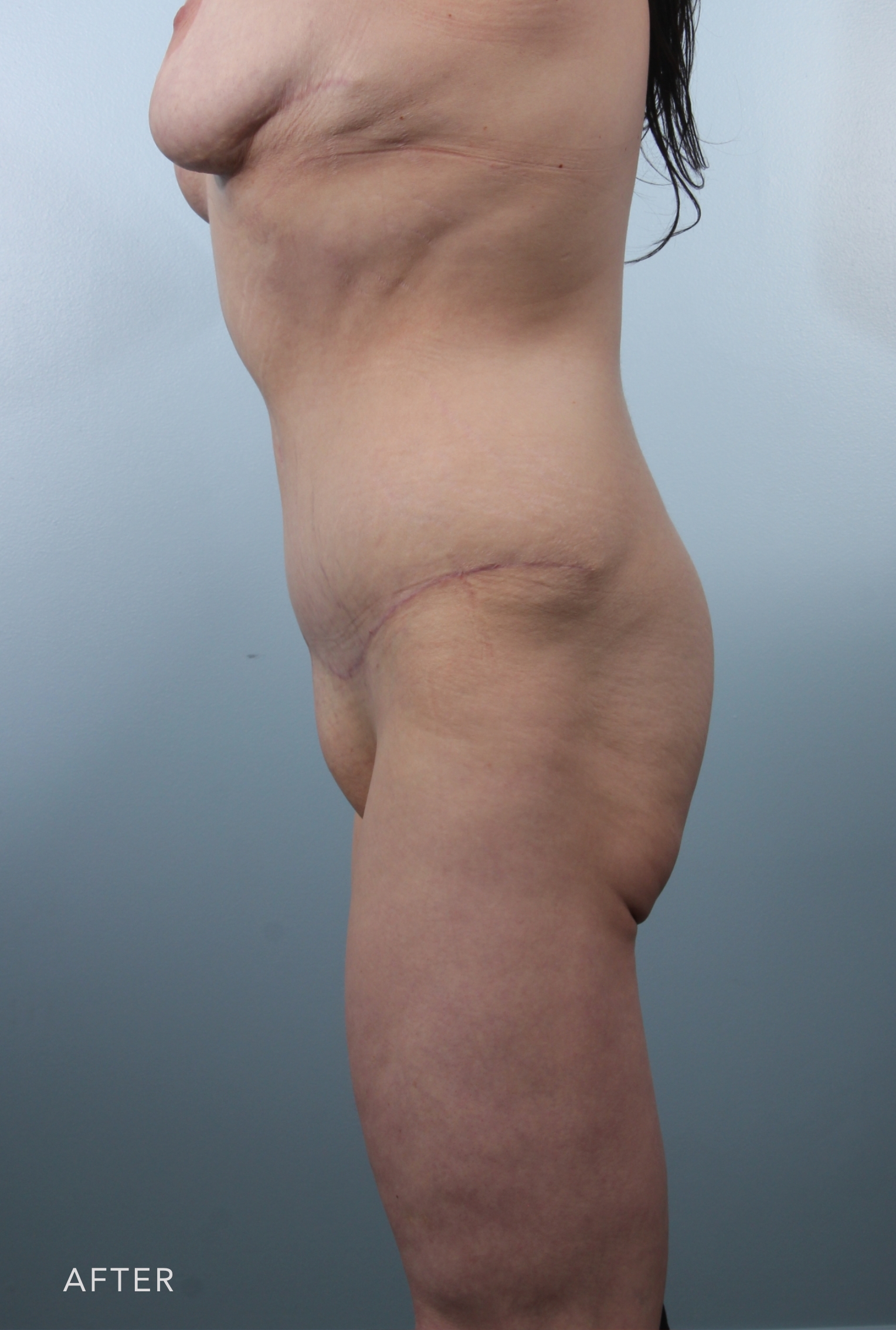 Procedure before and after - after