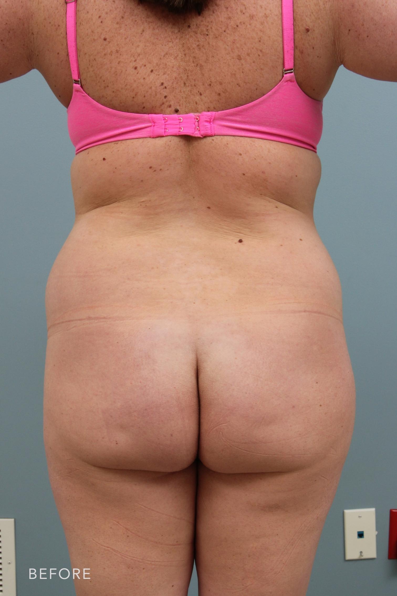Brazilian Butt Lift by Dr. Alfredo Lloreda — before