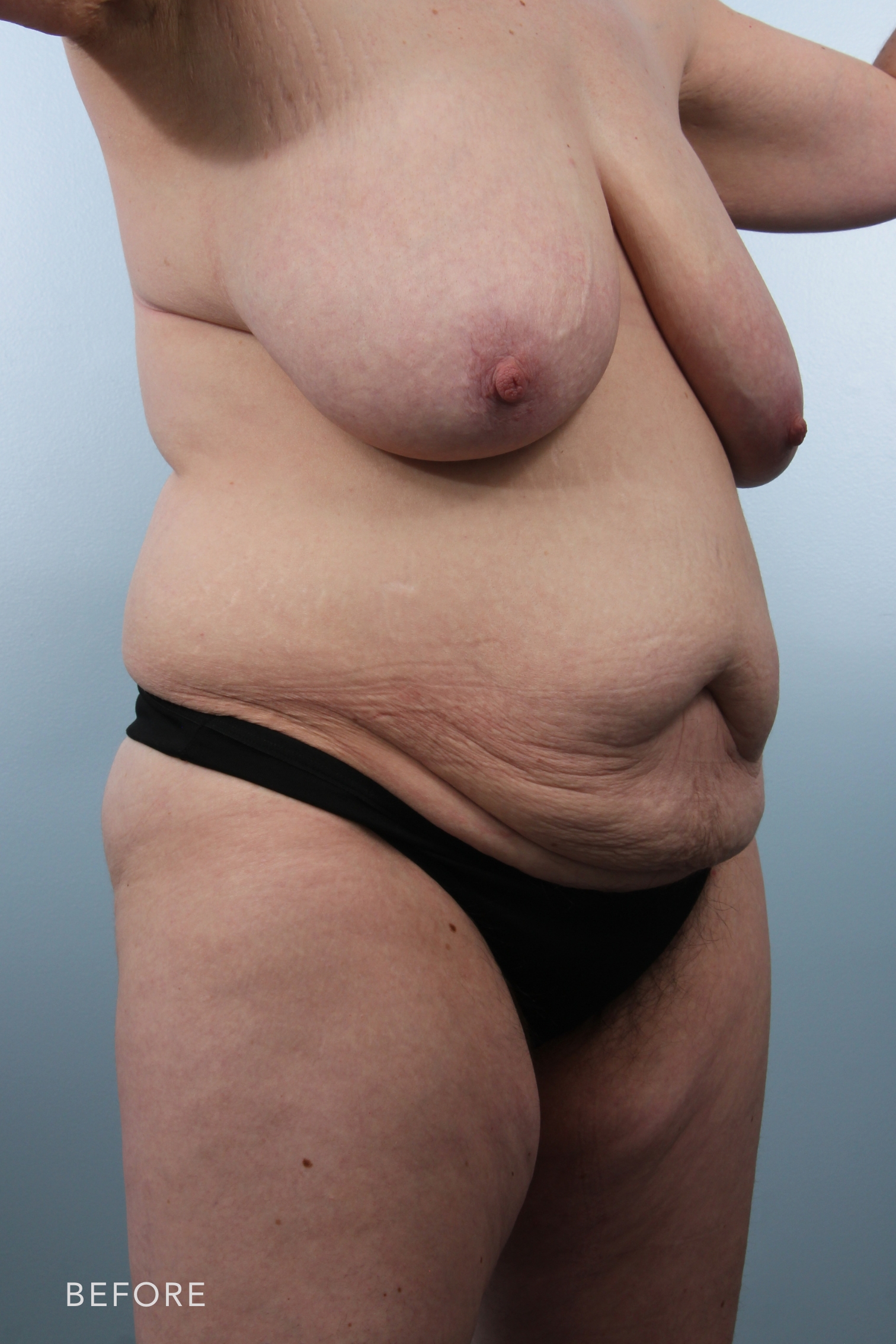 Mommy Makeover by Dr. Alfredo Lloreda — before