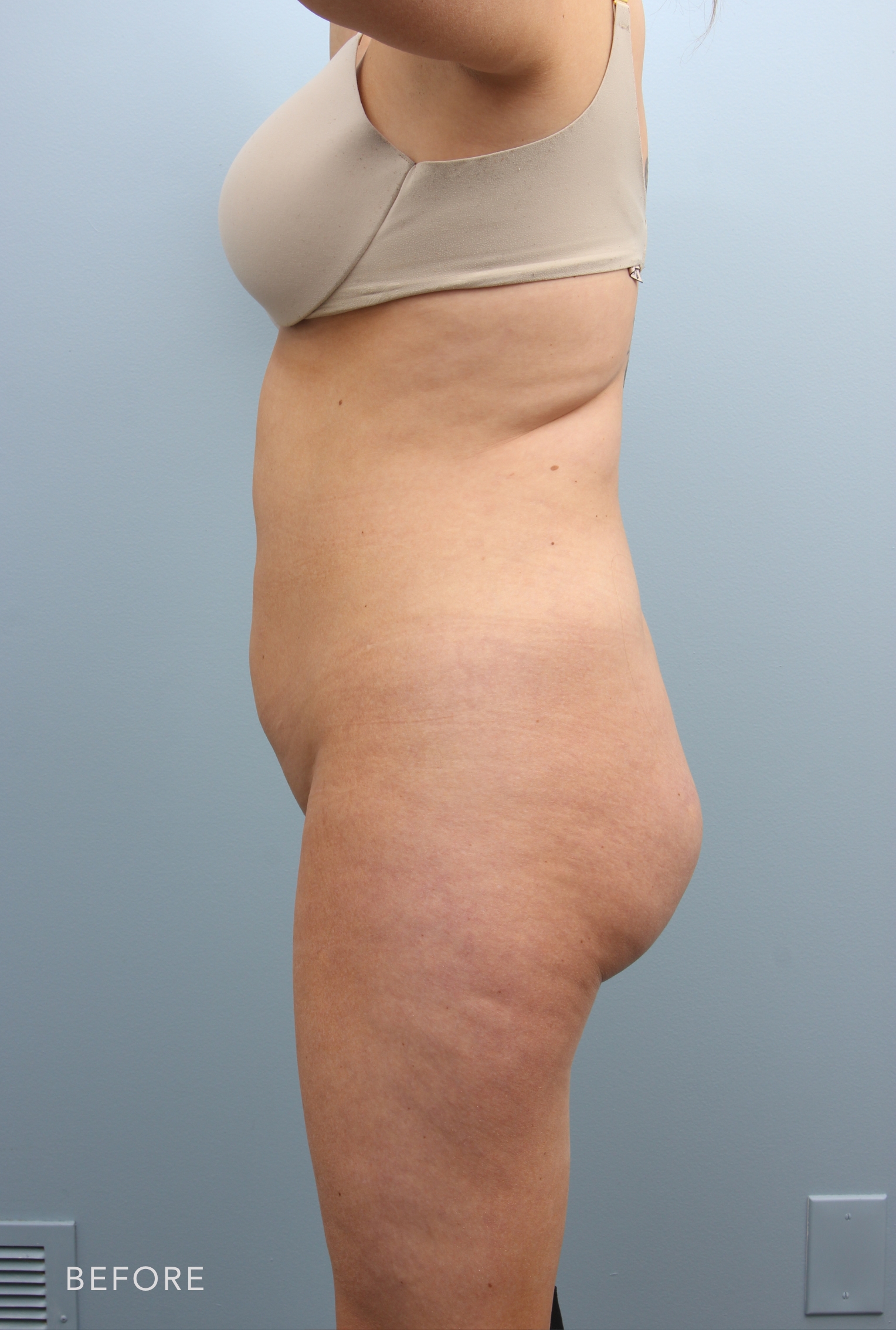 Tummy Tuck before — Dr. Alfredo Lloreda