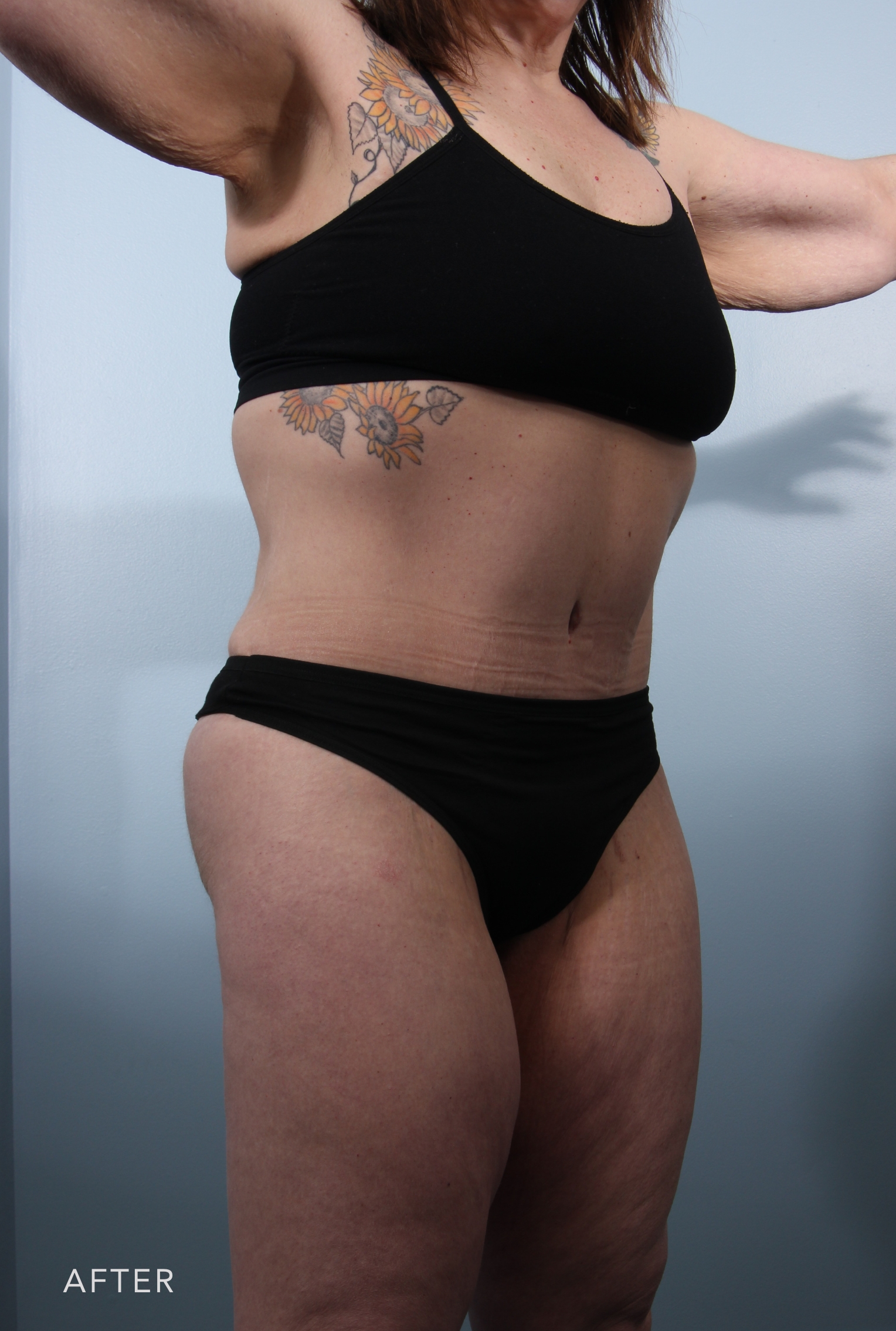 Procedure before and after - after