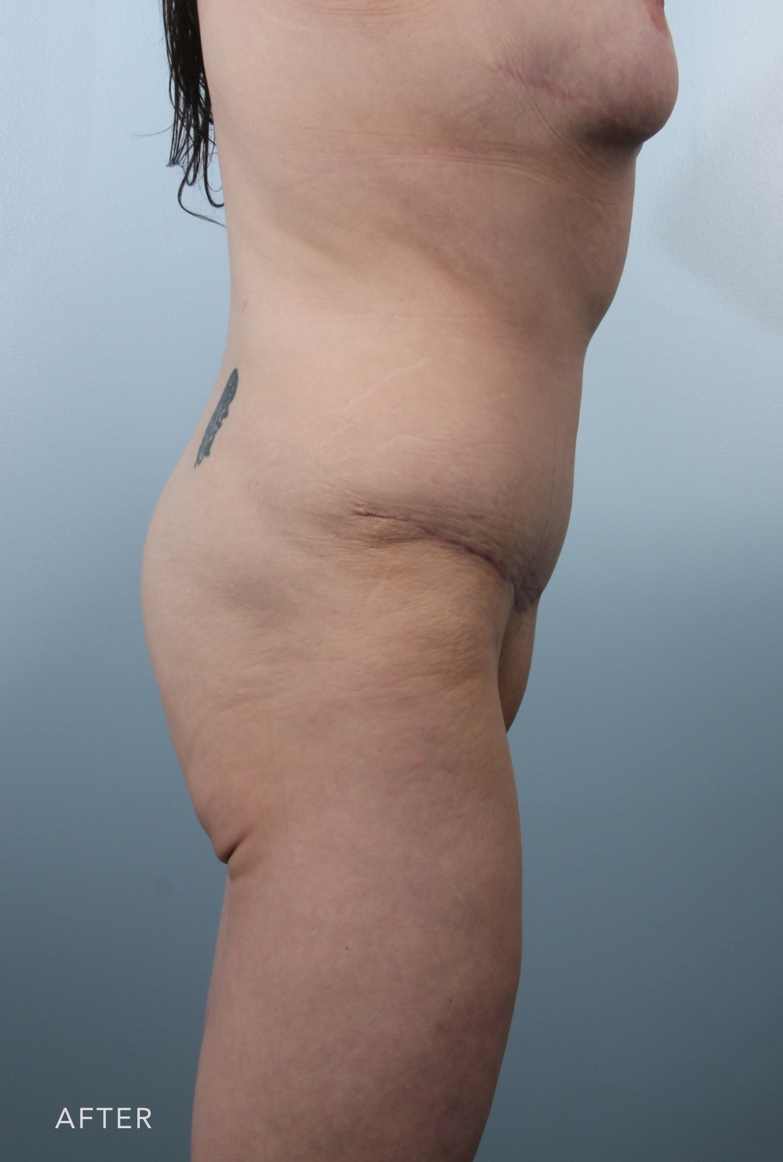 Procedure before and after - after