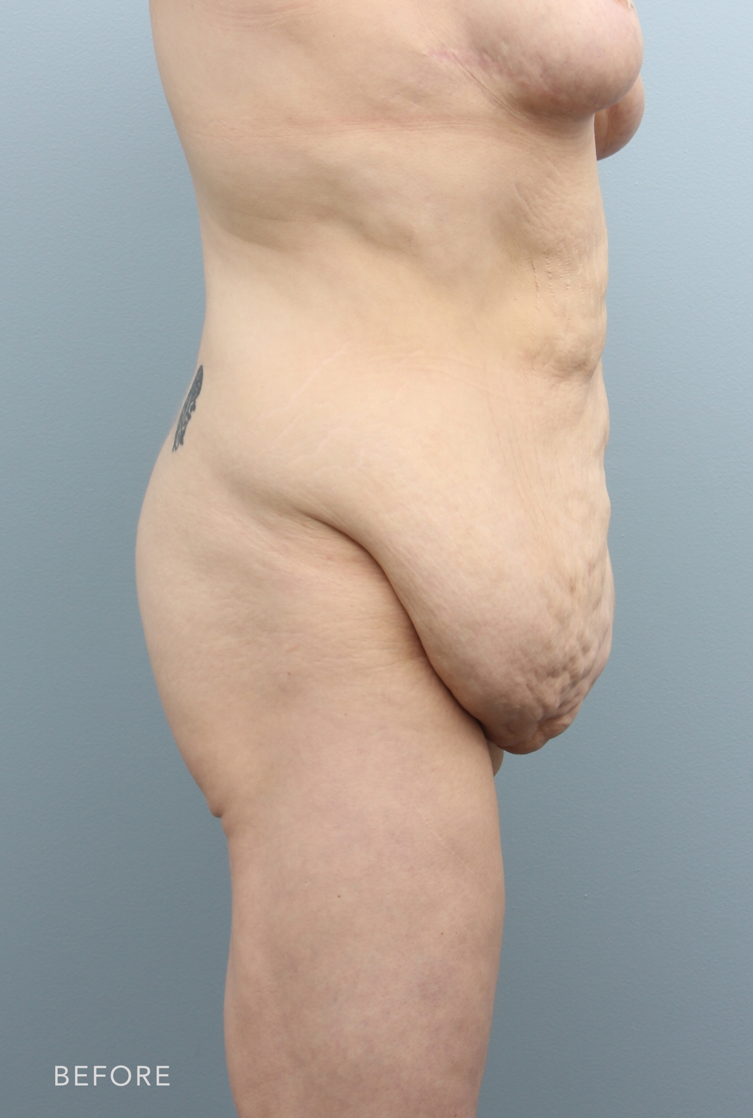 Procedure before and after - before
