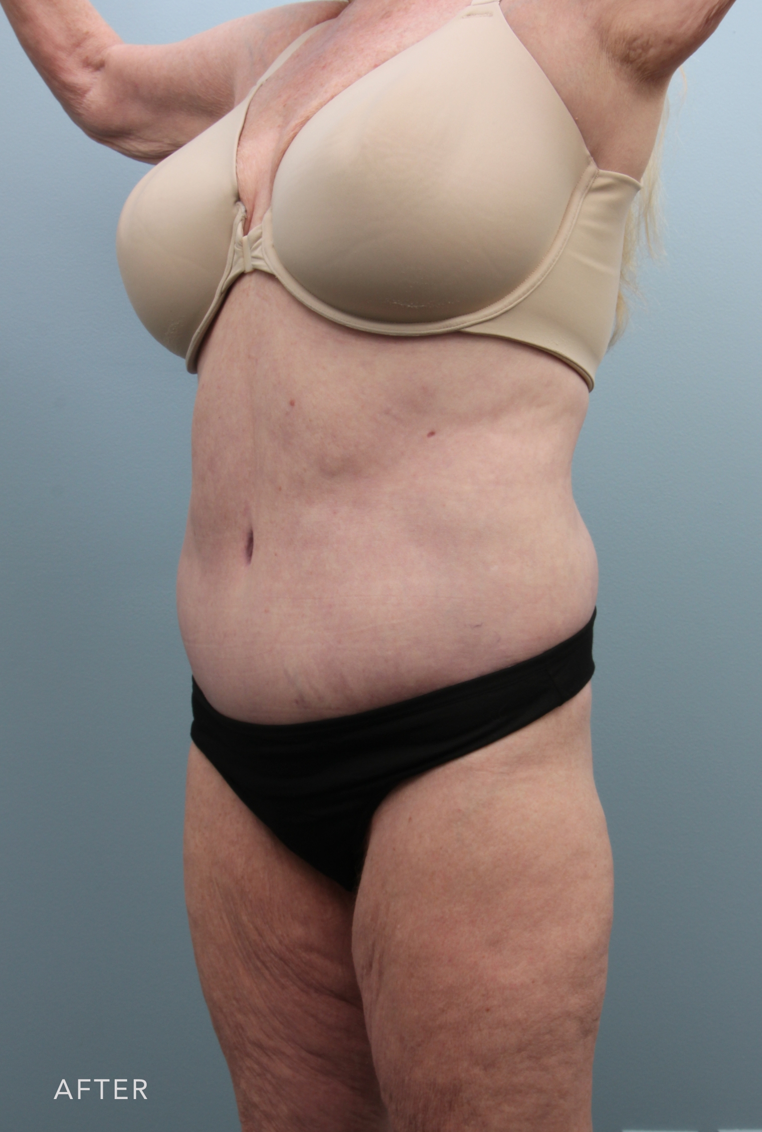 Body Lift after — Dr. Alfredo Lloreda