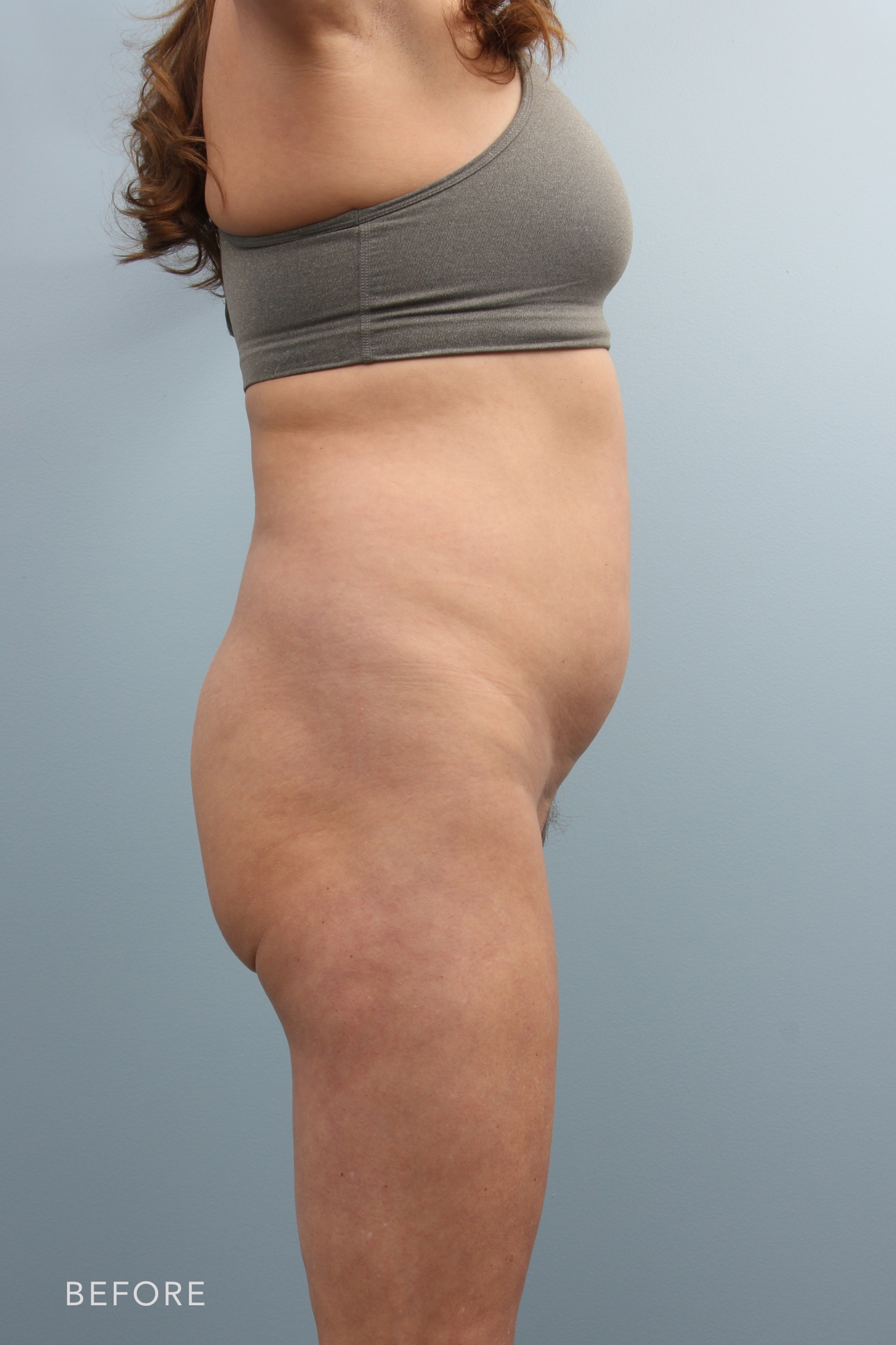 Liposuction before and after - before