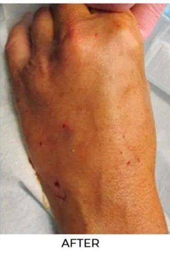 Procedure before and after - after
