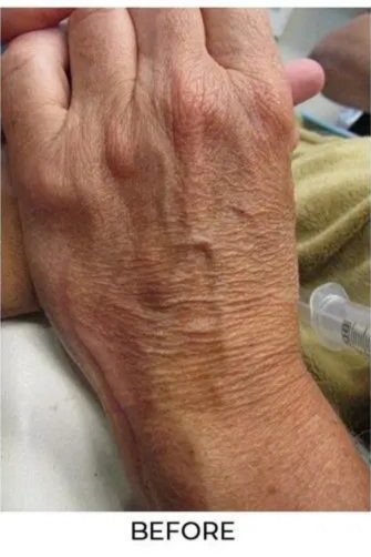 Procedure before and after - before