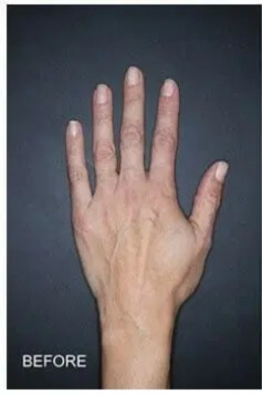 Procedure before and after - before