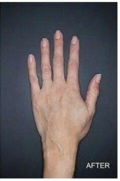 Procedure before and after - after