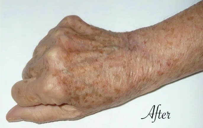 Procedure before and after - after