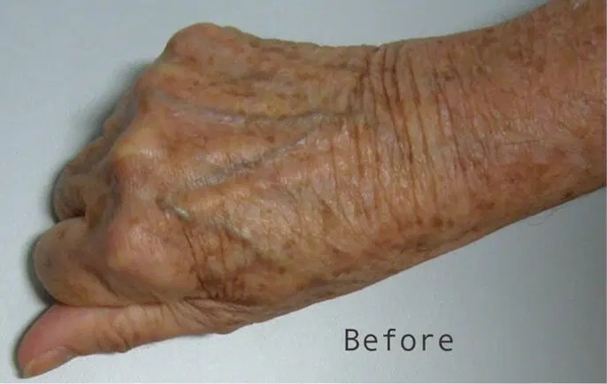 Procedure before and after - before
