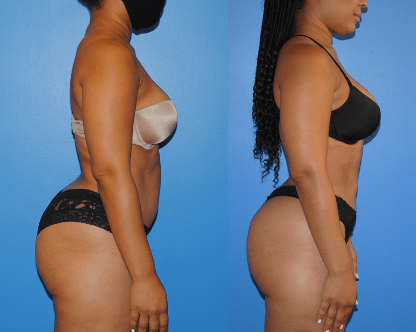 Liposuction before and after - after
