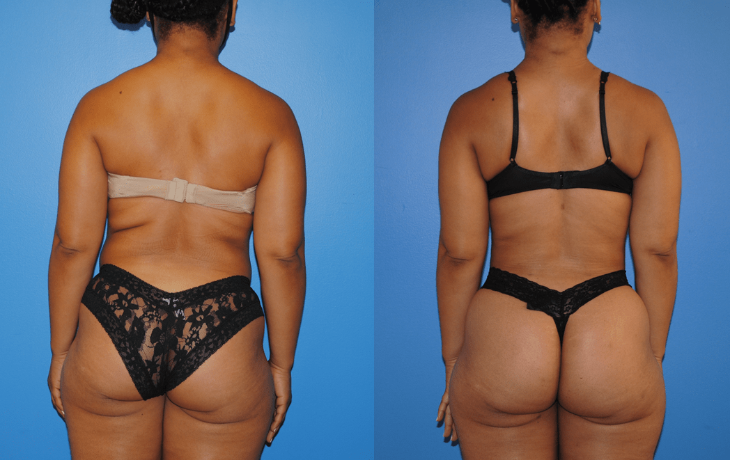 Liposuction before and after - before