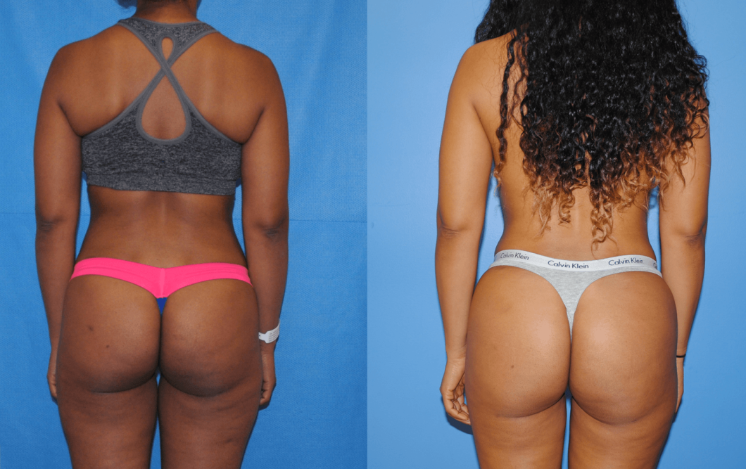 Liposuction before and after - after