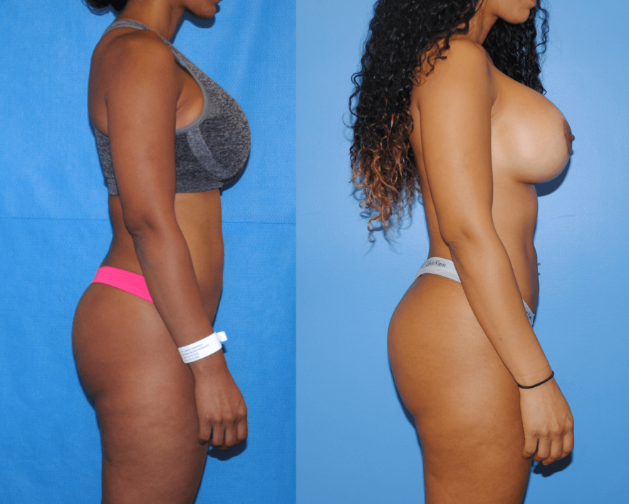 Liposuction before and after - before