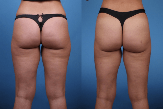 Liposuction before and after - after