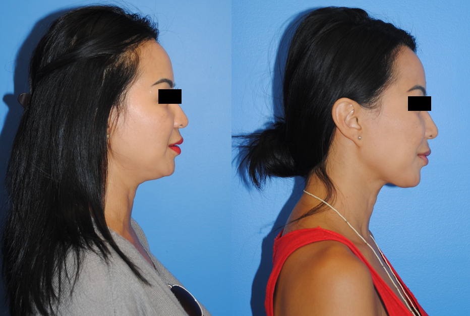 Liposuction before and after - before