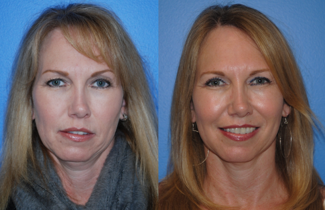 Male Blepharoplasty before and after - after