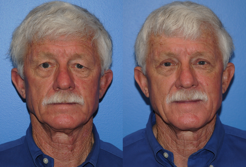 Male Blepharoplasty before and after - before