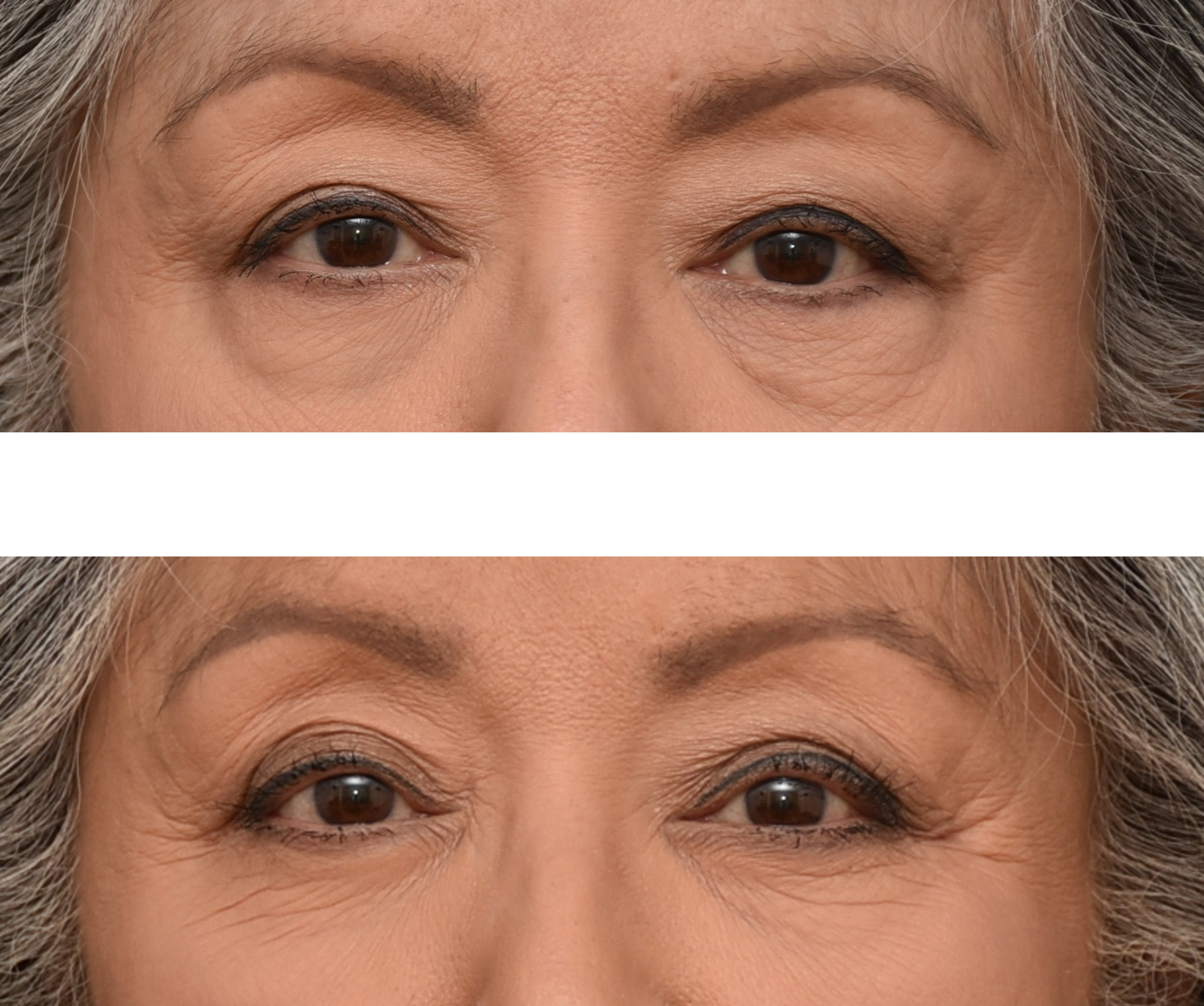 Blepharoplasty before and after - after