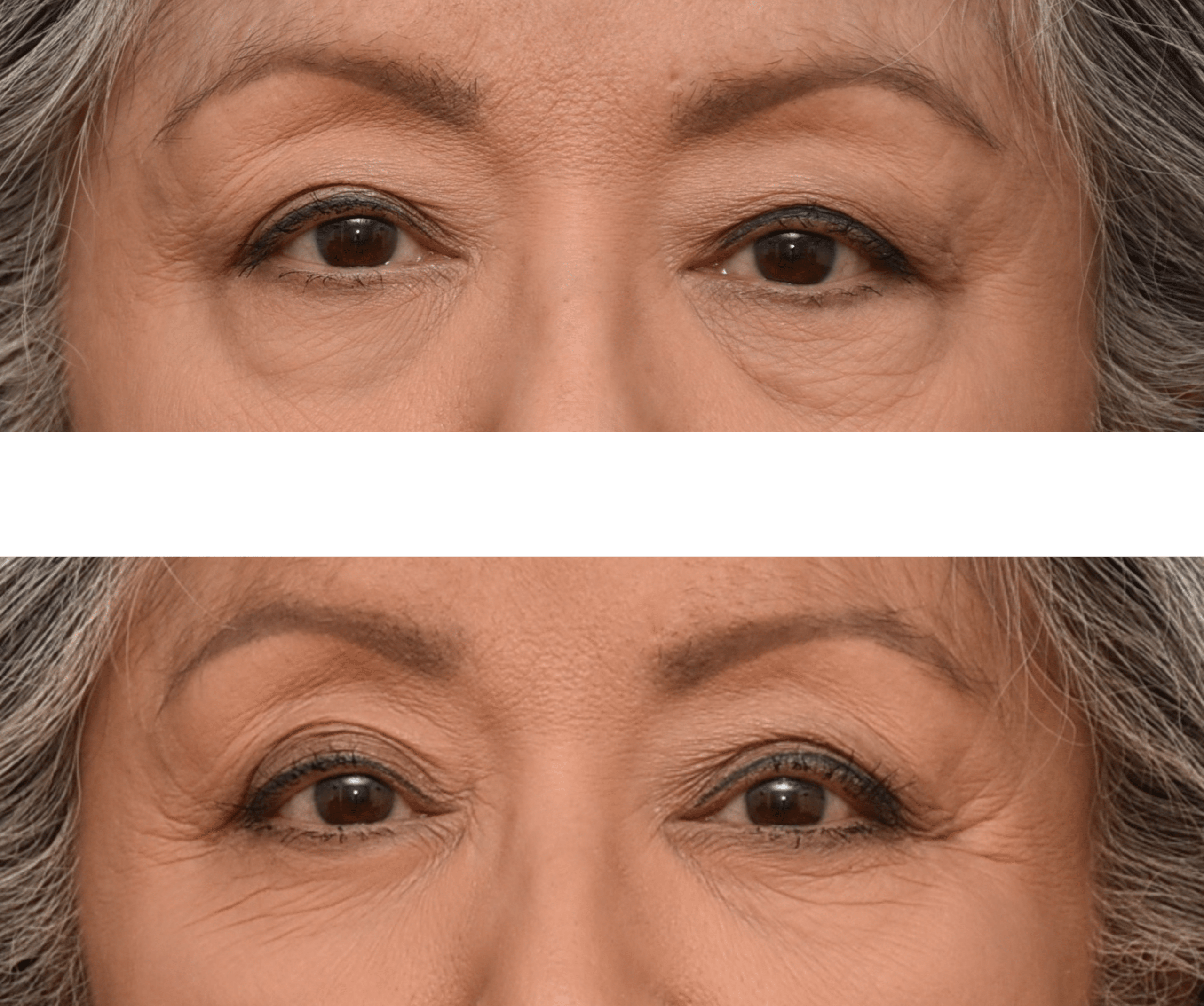 Blepharoplasty before and after - before
