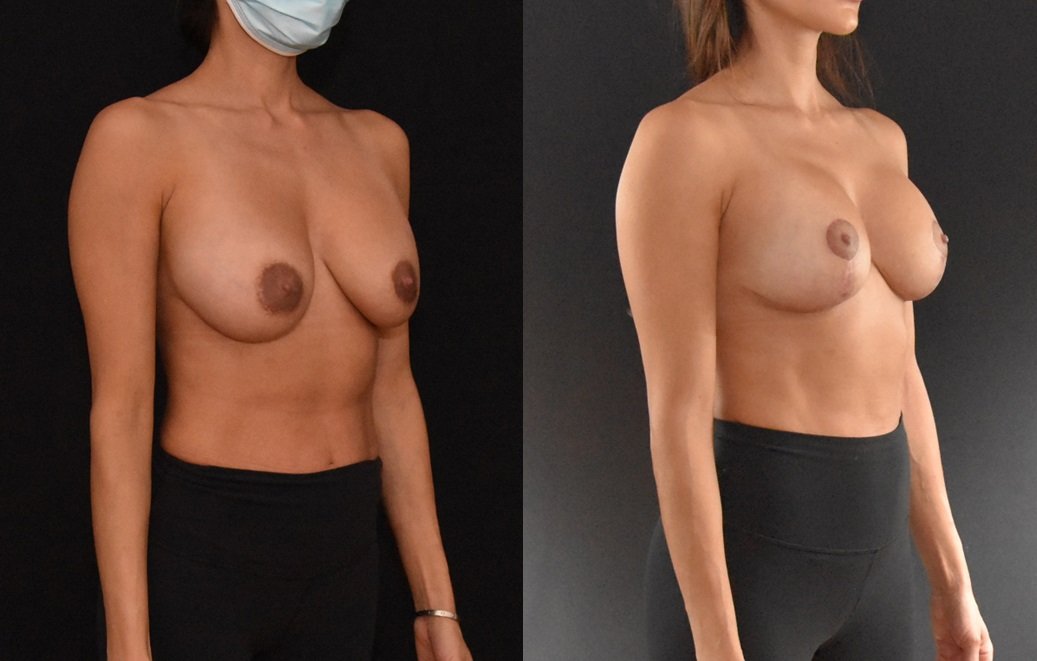 Secondary Mastopexy Augmentation before and after - after
