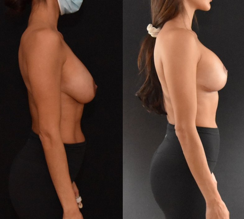 Secondary Mastopexy Augmentation before and after - before