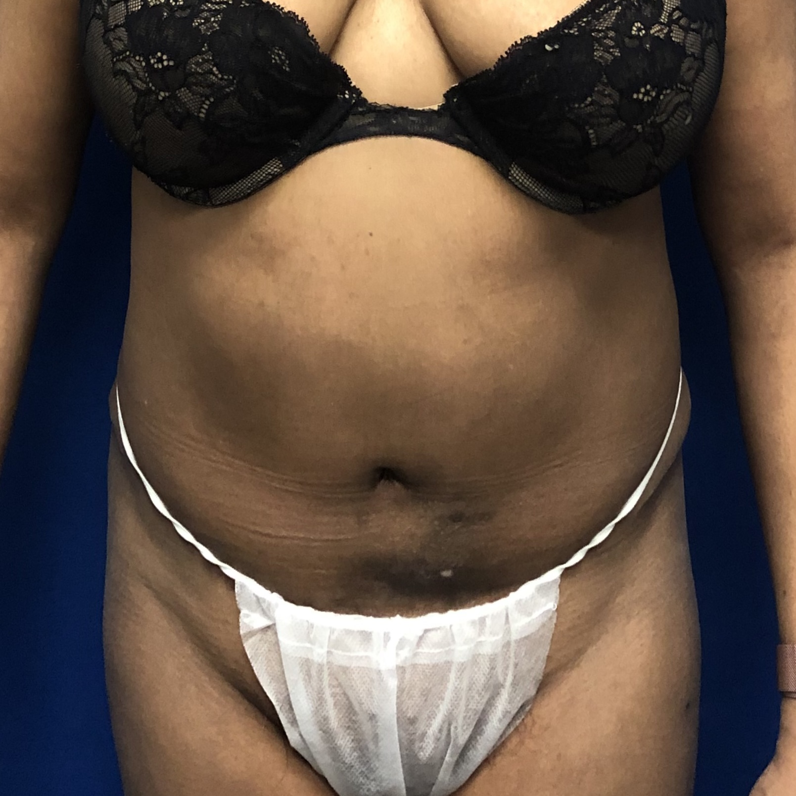 Procedure before and after - after