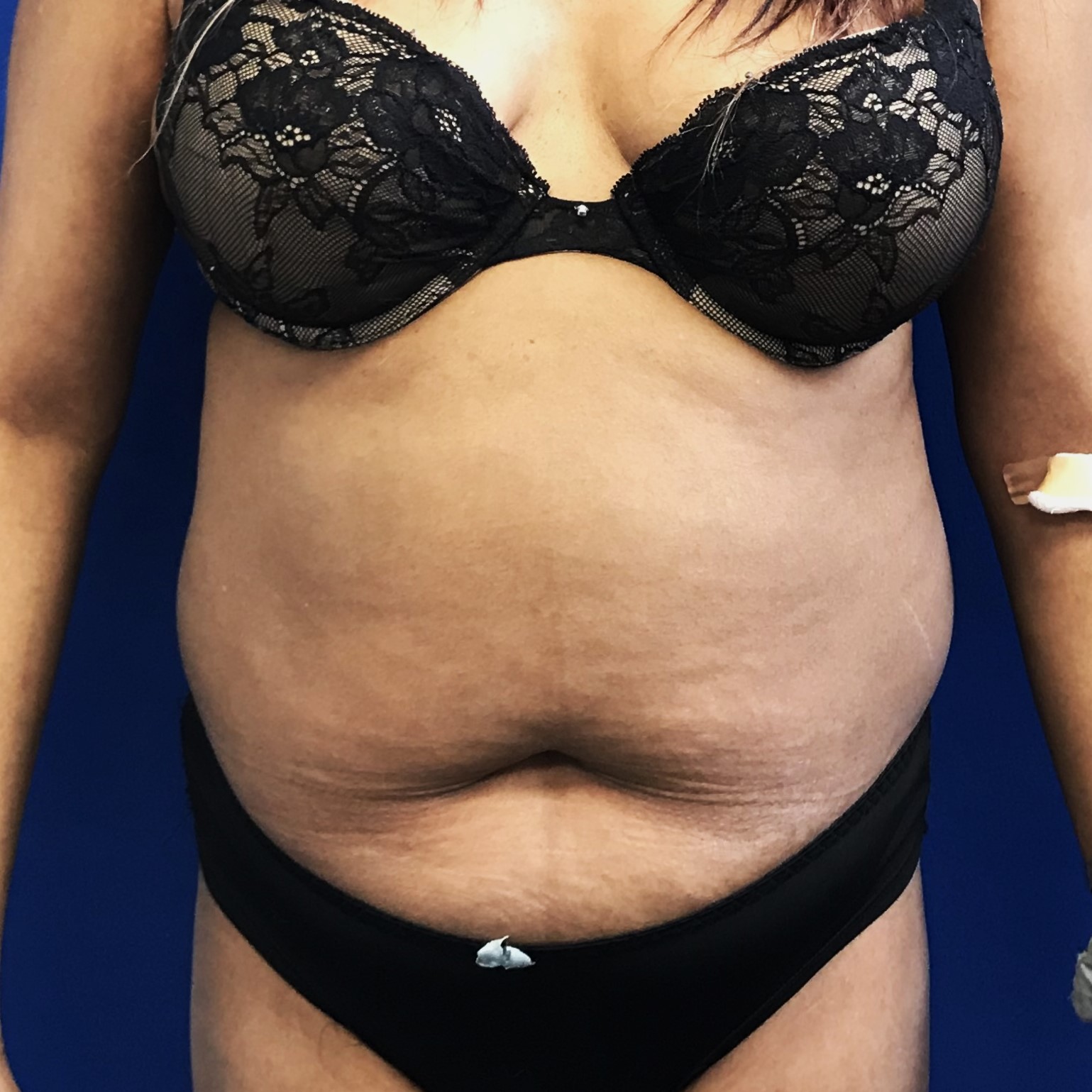 Procedure before and after - before